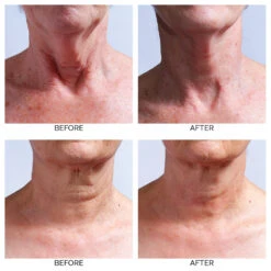 SilcSkin Collette Pads -LA ROCHE-POSAY || Murad || SkinMedica Sales SIC0004.5